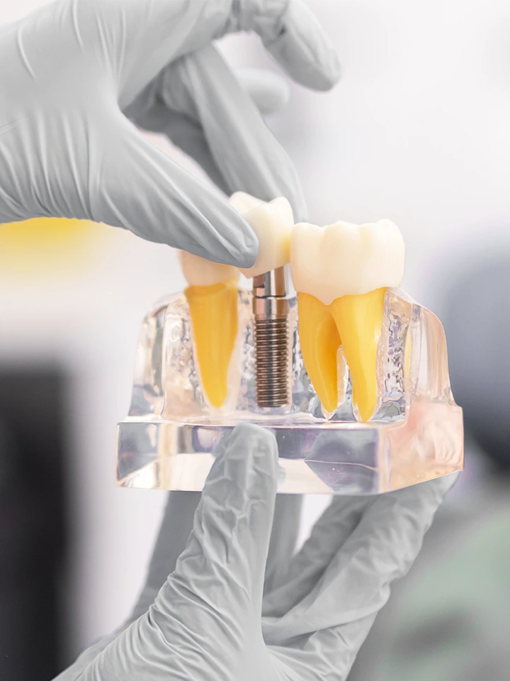 Resultado de implantes dentários